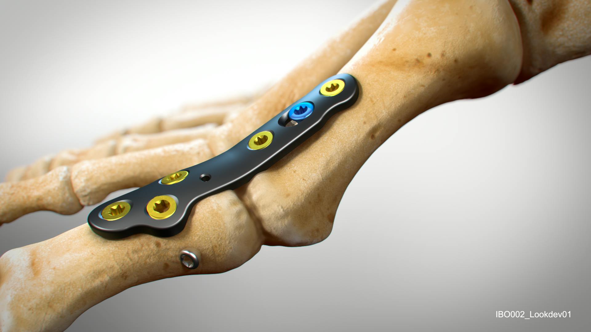 In2Bines CoLink plate on bone 