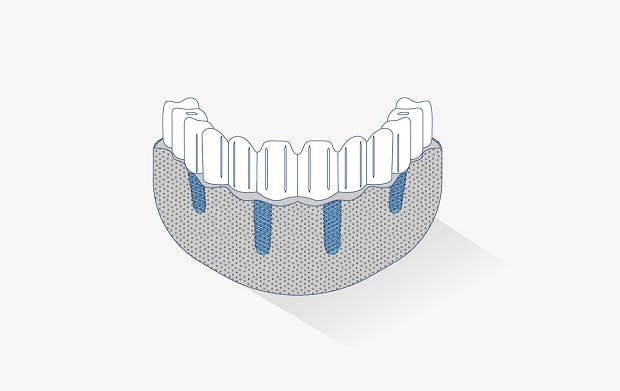 Dental full arch
