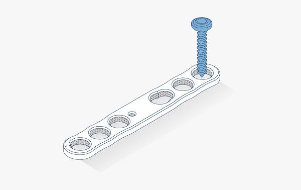 Foot and ankle toe plate