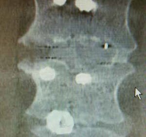 Timothy Bassett Spinal News Xray image