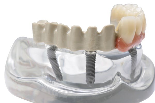 Dental full arch