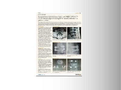 Timothy Bassett Spinal News